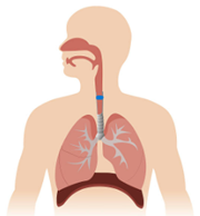 diagrama de obstrucción parcial de las vías respiratorias